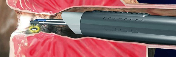 operacion prostata vaporizacion galicia