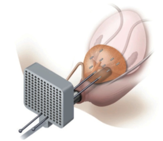 braquiterapia prostata galicia