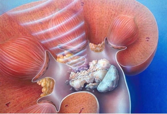 litotricia calculo ri&ntilde;on coru&ntilde;a