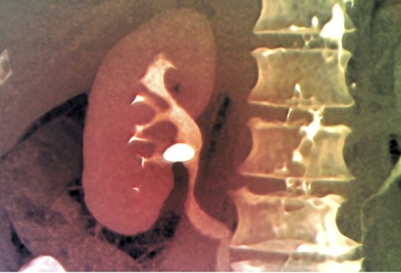 piedra clico renal coru&ntilde;a